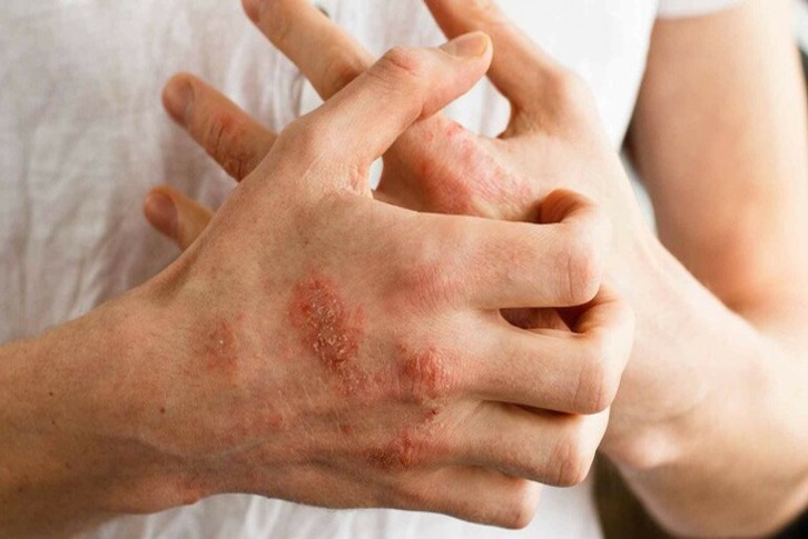 Chế độ ăn Keto cho bệnh tự miễn: Lợi ích đối với Lupus, MS và Crohn